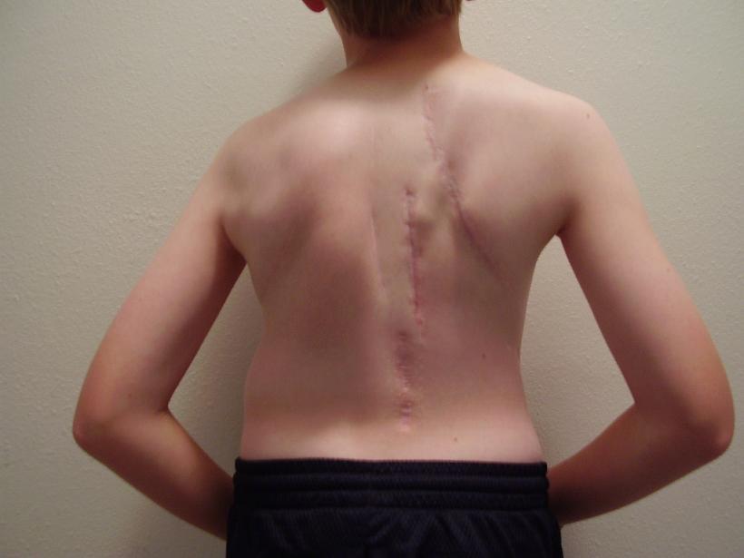 My Spine Sticks Out – Should I be Concerned?